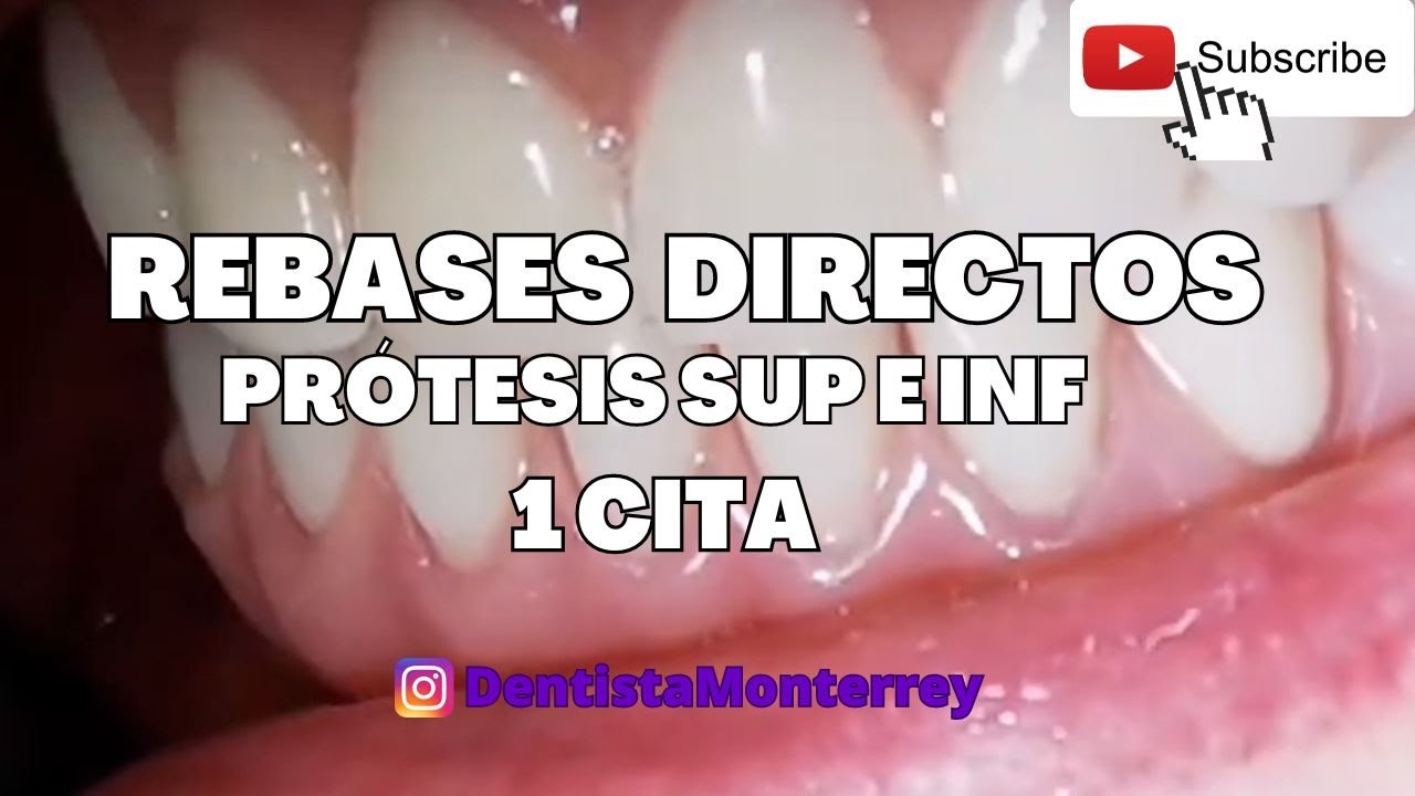 Rebases 👅 Prótesis Totales FLOJAS  en 1 CITA
