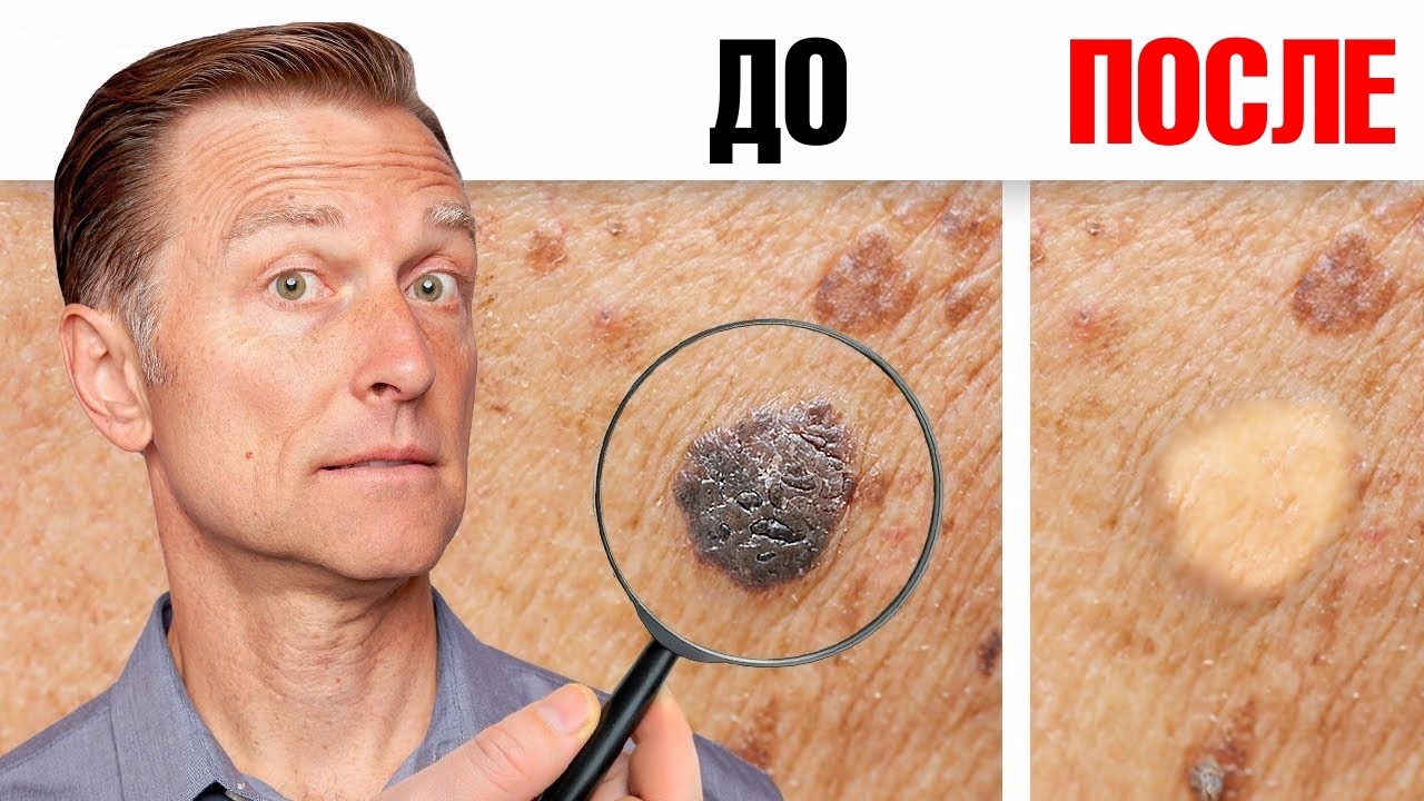 Как избавиться от папиллом и бородавок за ОДНУ ночь?👀
