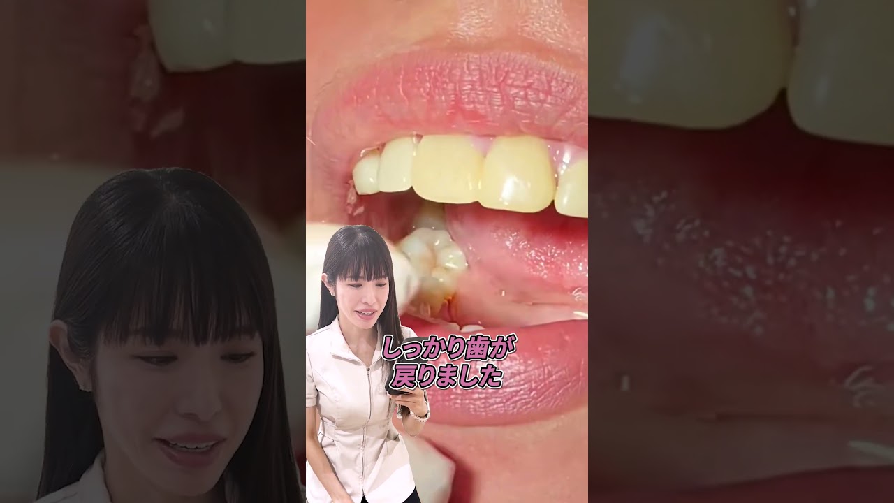 バネなし入れ歯で自然笑顔復活♪ #入れ歯  #歯医者 #ノンクラスプデンチャー