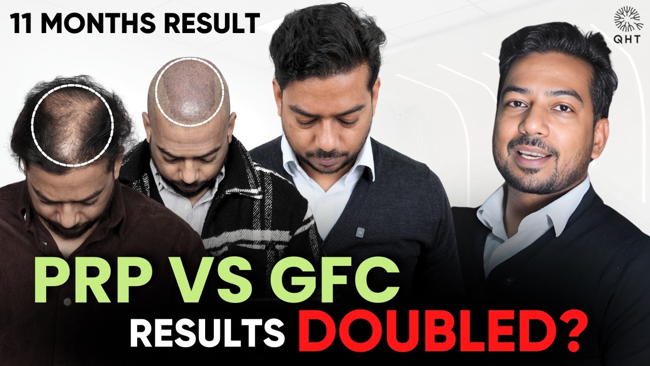 Amazing Result: 11 Months Hair Transplant Result | PRP VS GFC | QHT Clinic | Hair Transplant Result