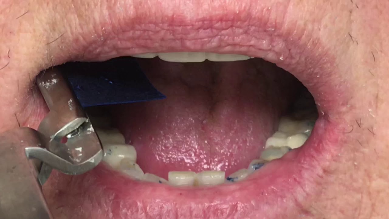 Houston Cosmetic Dentist...How to adjust the Snap-on Smile...Internet appliances do not do this!