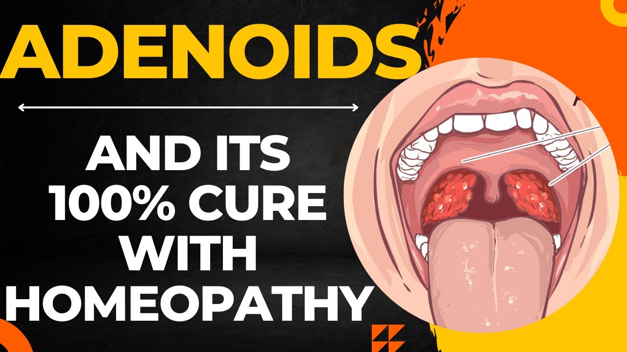 ADENOIDS || BEST HOMEOPATHIC MEDICINE FOR ADENOIDS || ADENOIDS HOMEOPATHIC MEDICINE !