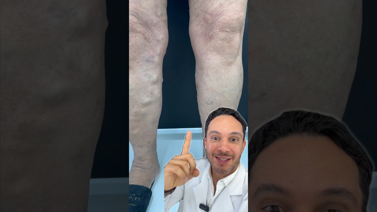 #safena #medicina #clinicavascular #varizes