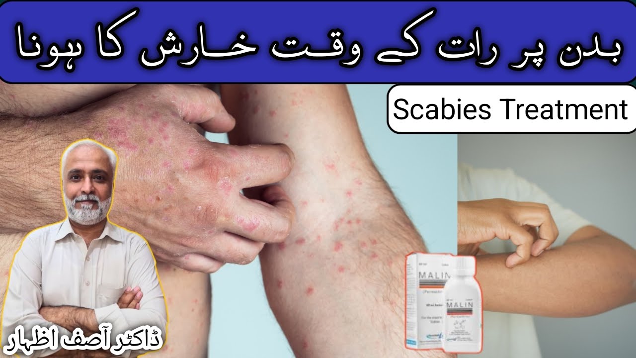 Malin Lotion Uses In Urdu | Permethrin Lotion How To Use | Scabion Lotion | Scabies Treatment 