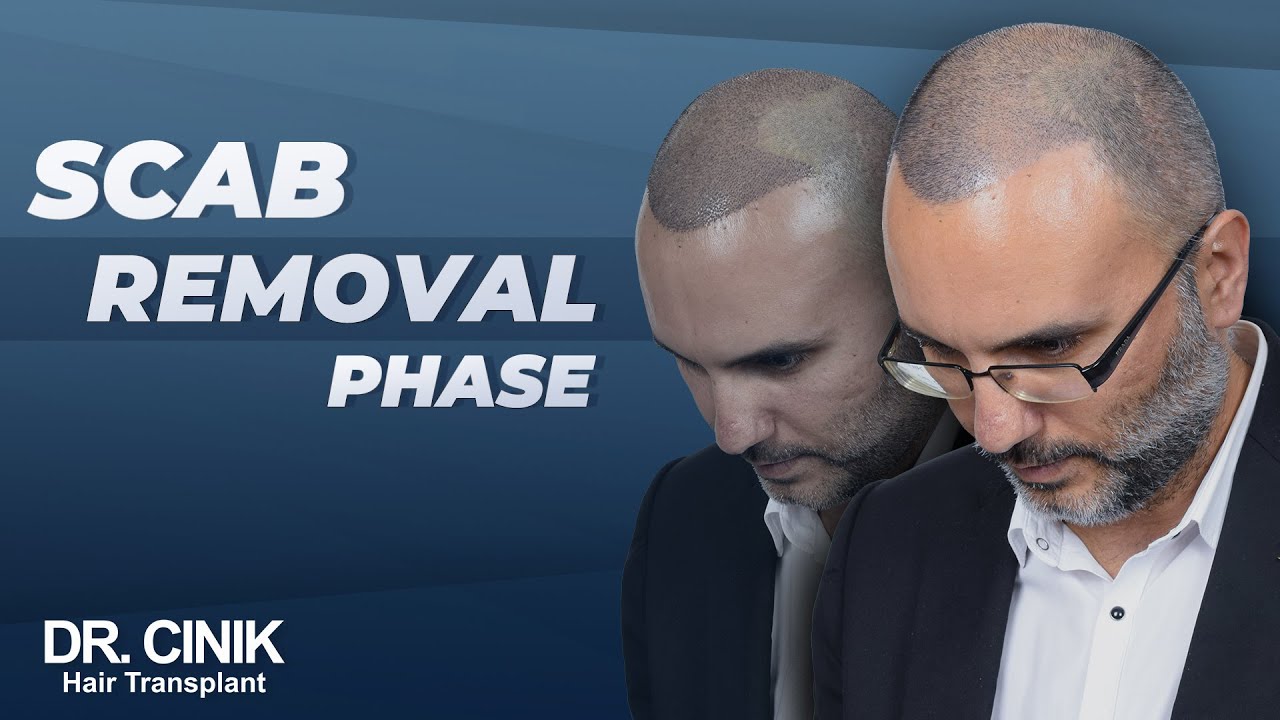 Scab Removal Phase | Dr.Cinik Hair Transplant