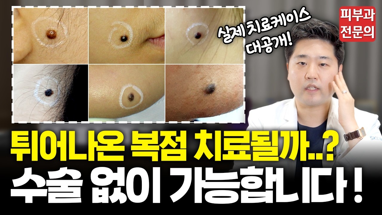 입술 옆에, 턱 밑에 툭! 튀어나온 대왕 복점! '선천성모반', '진피내모반'ㅣ수술 없이 레이저로 확실하게 없애는 방법!