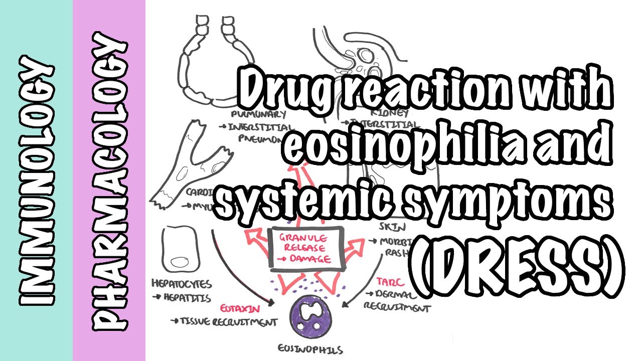 DRESS Syndrome (drug related eosinophilia)  - causes, pathophysiology, signs and symptoms, treatment