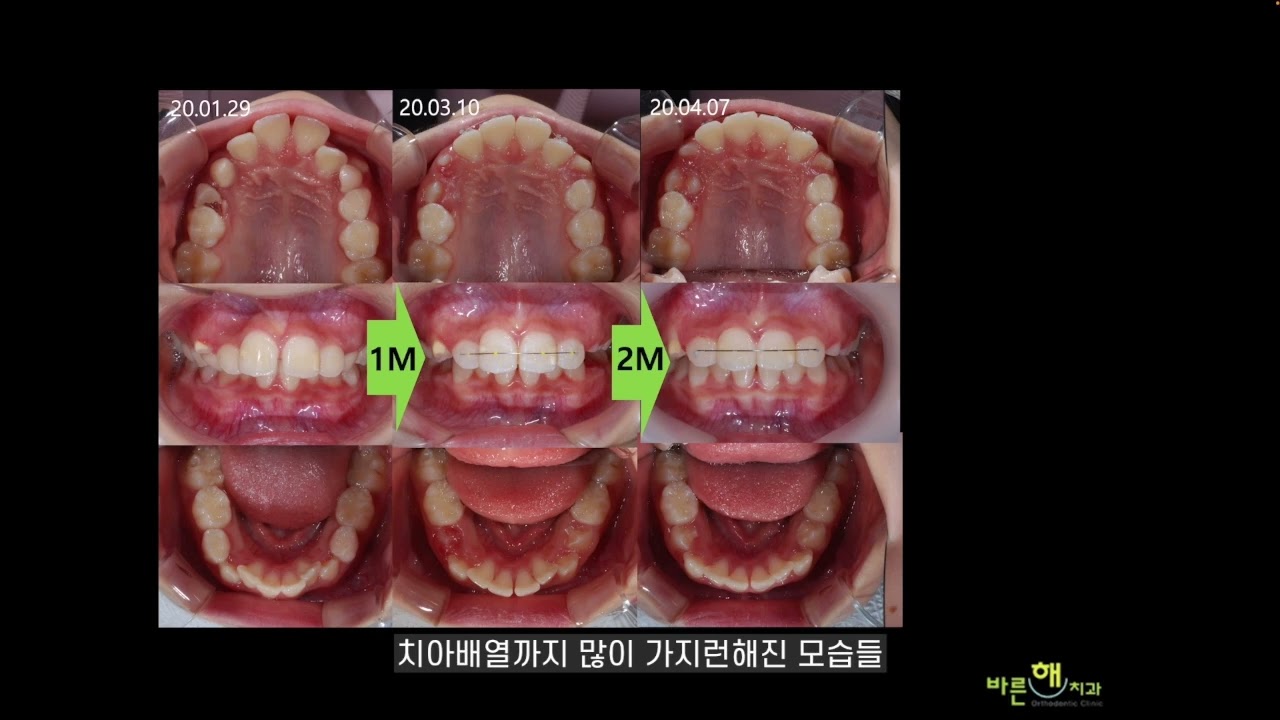 어린이 부정교합 치료 사례 (무턱, 윗턱이 나왔어요!)