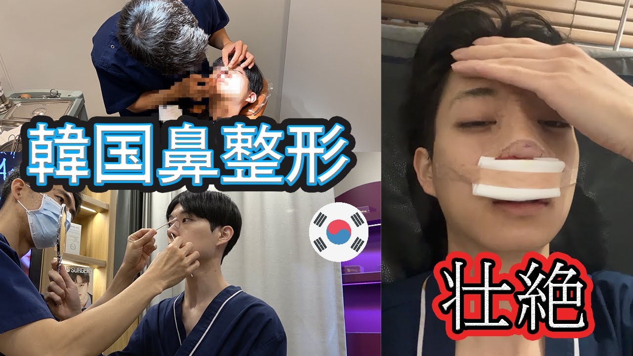 韓国留学生...韓国で鼻整形しました！【子鼻縮小/鷲鼻/鼻筋高さ】#DA美容外科#韓国整形#輪郭手術#輪郭3点#ダウンタイム#美容整形#韓国整形＃自己肯定感上がった