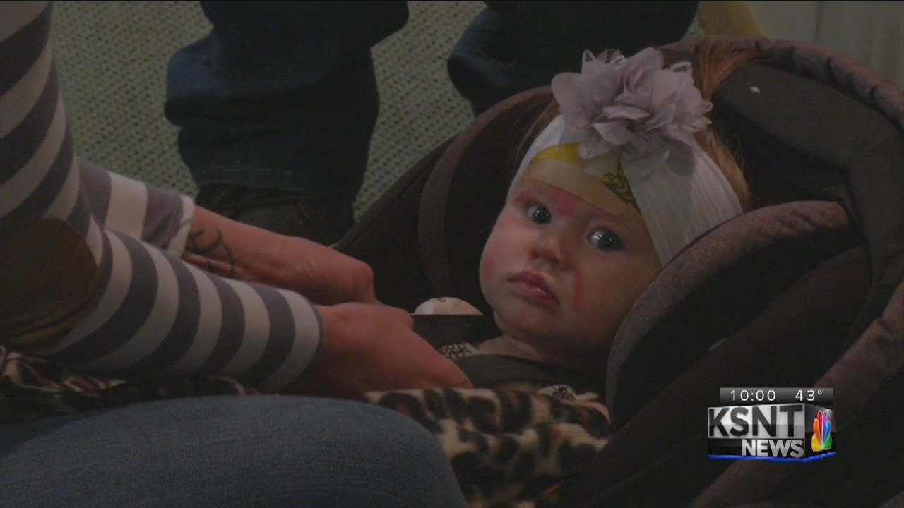 Local baby burned in fire on the road to recovery