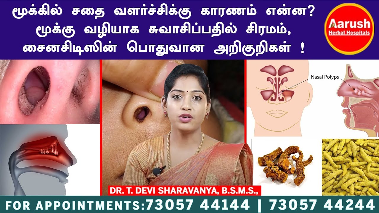 மூக்கில் சதை வளர்ச்சிக்கு காரணம் என்ன? மூக்கு வழியாக சுவாசிப்பதில் சிரமம் சைனசிடிஸின் அறிகுறிகள் !