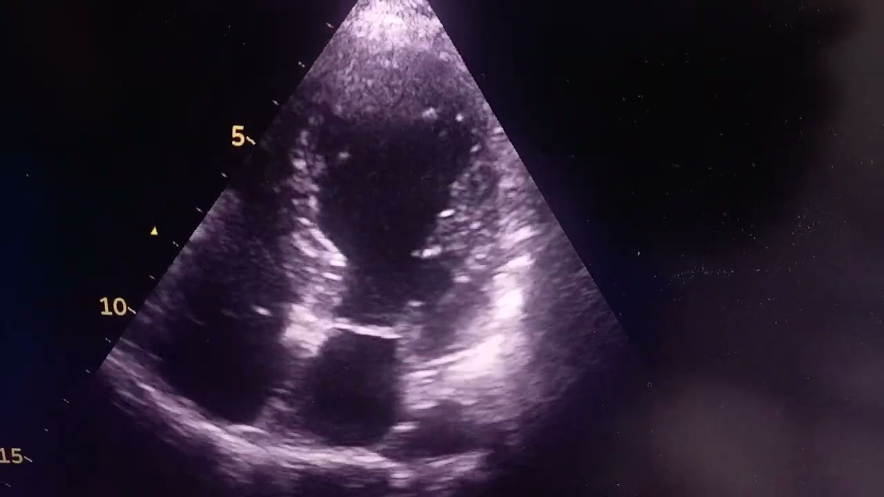 Tacotsubo cardiomyopathy, HF with normal coronaries 