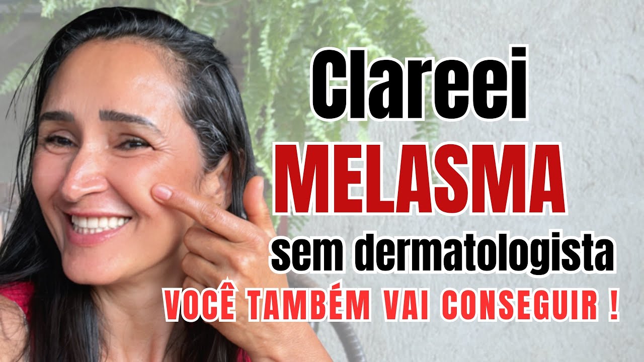 Como Clareei o Melasma Naturalmente Sem Dermatologista e Sem Gastar Muito 