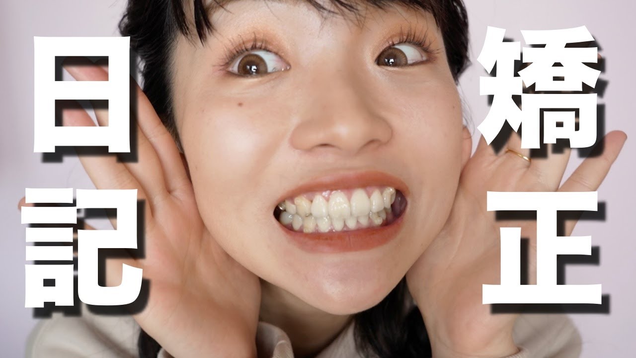 【矯正日記】１年ちょっと経過しました！痛みは？歯並びは？など語ってます。