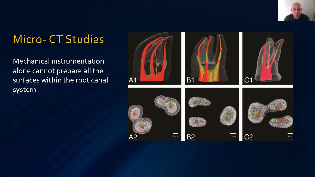 Safe & Effective Endodontics Irrigation: Top Tips for GDPs By Dr Ammar Al-Hourani