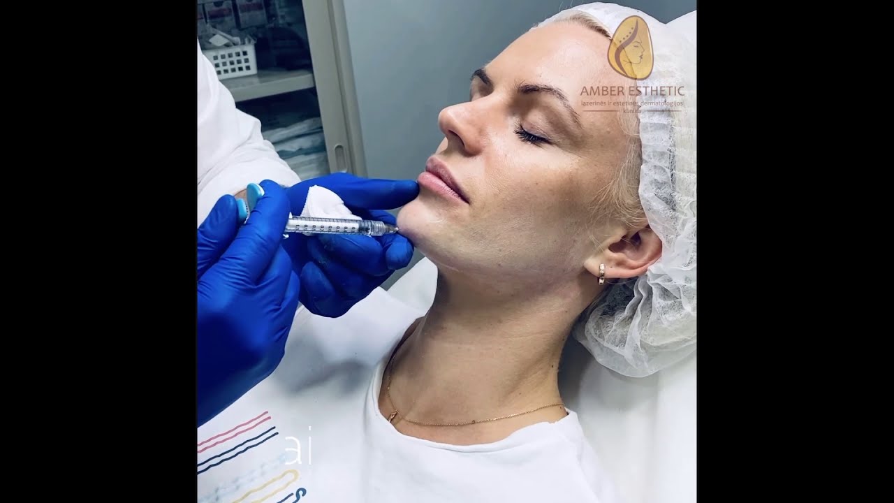 Žandikaulio linijos kontūravimas užpildais | www.amberesthetic.lt