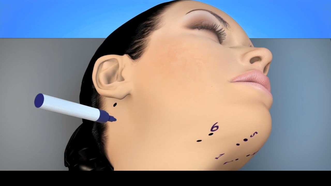 MyEllevate Procedure with Renuvion Skin Tightening