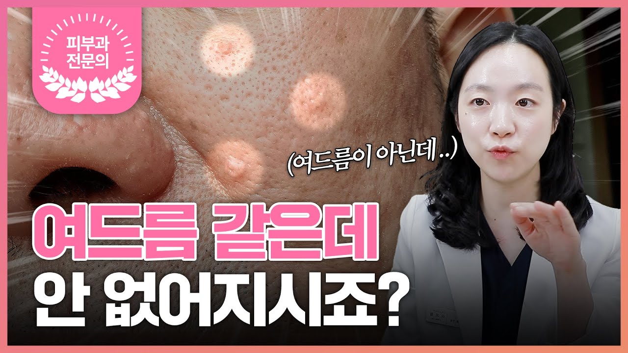 '피지샘증식증'일 수 있습니다!🤫 서울대출신 피부과 전문의가 알려주는 피지샘증식증의 모든 것!