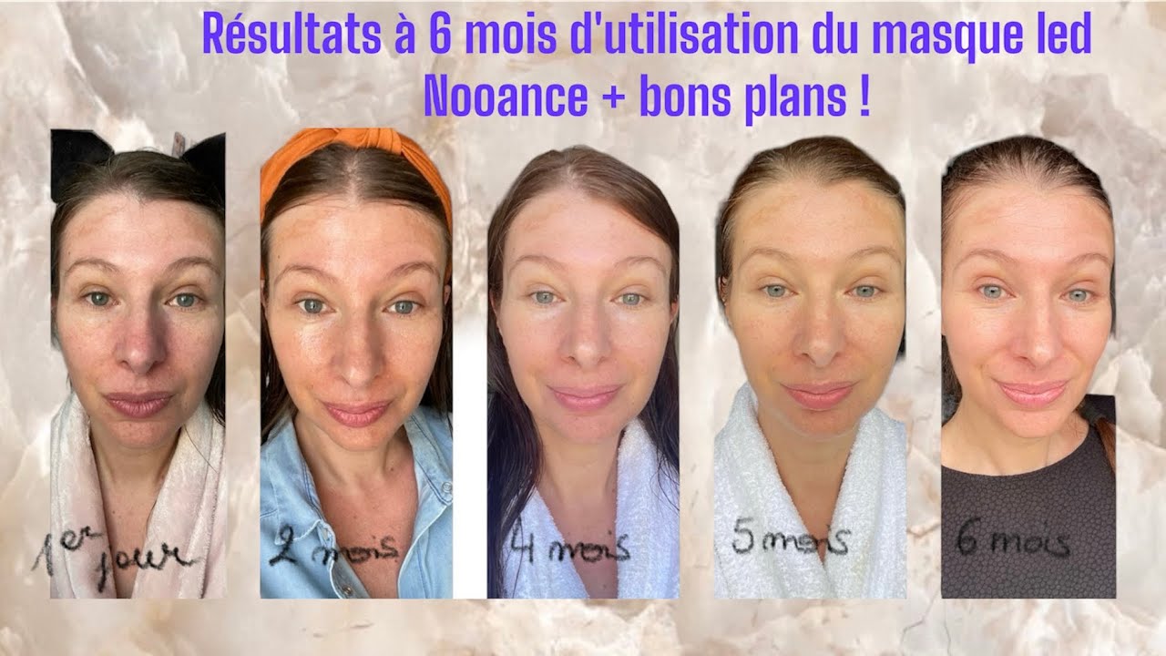 Résultats à 6 mois d’utilisation du masque led Nooance + Bons plans
