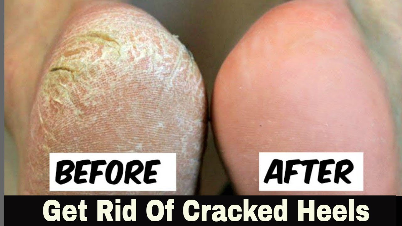 I Tried This Natural Heel Remedy for 3 Days… The Results Were INSANE!