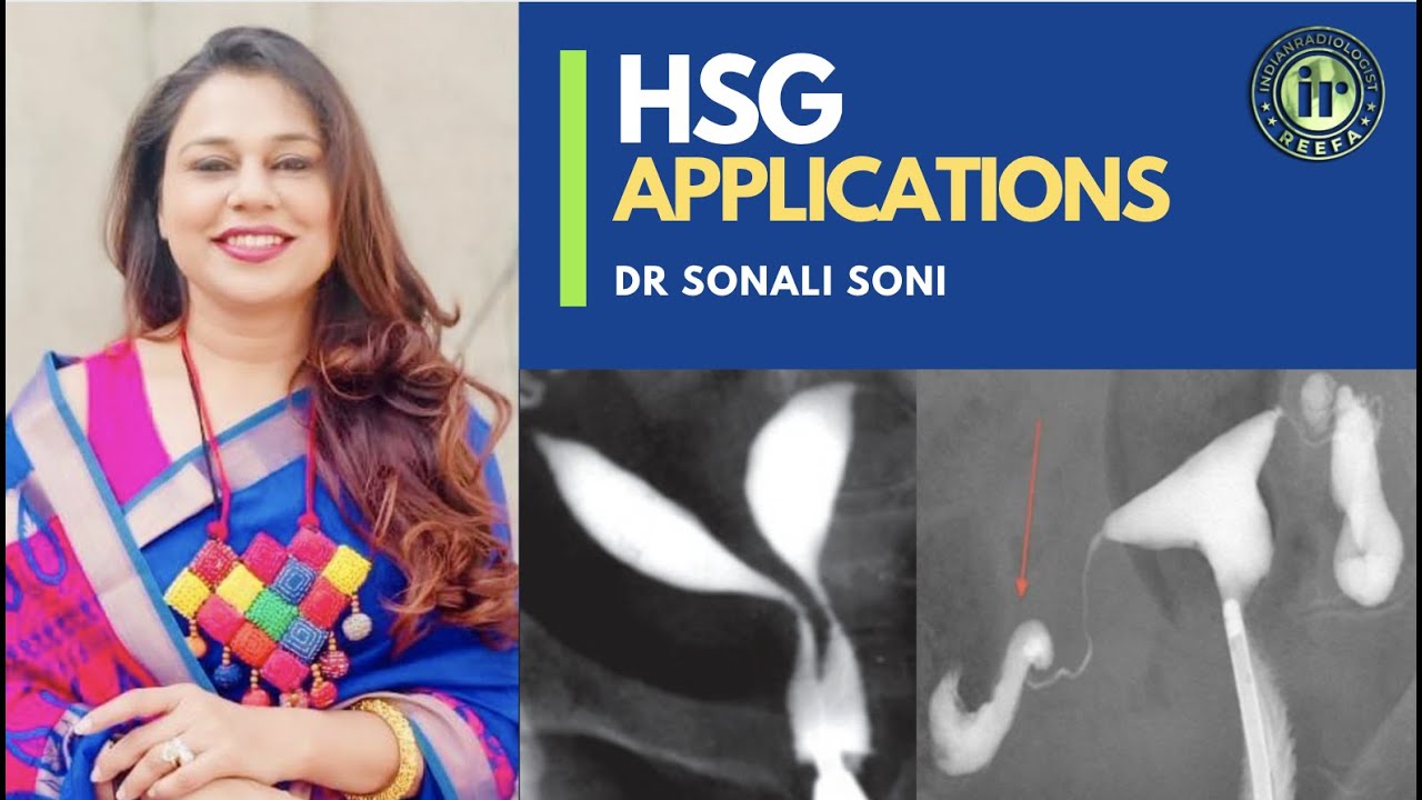 HYSTEROSALPINGOGRAPHY | DR SONALI SONI | TUBAL BLOCK | HYDROSALPINX | INFERTILITY | MULLERIAN DEFECT