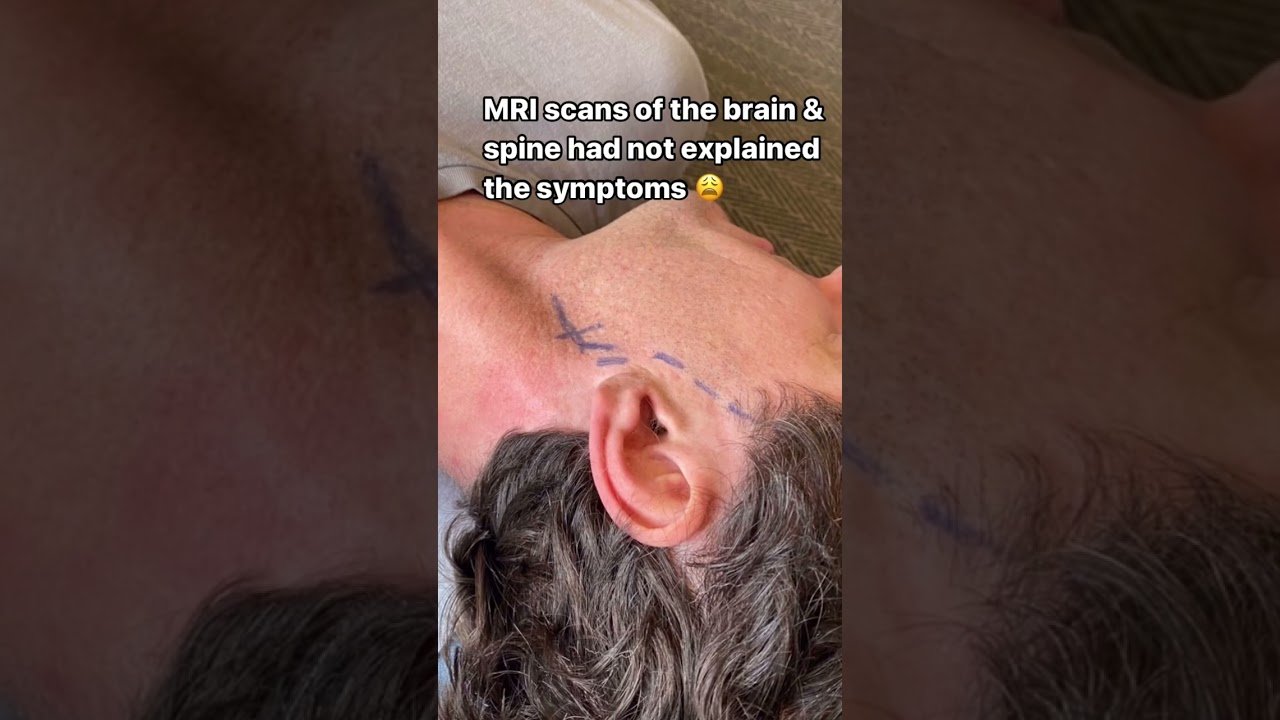 Headaches, jaw pain & facial tension; caused by nerve entrapment