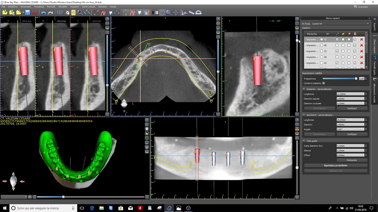 Progetto di Riabilitazione full-arch con intervento flapless