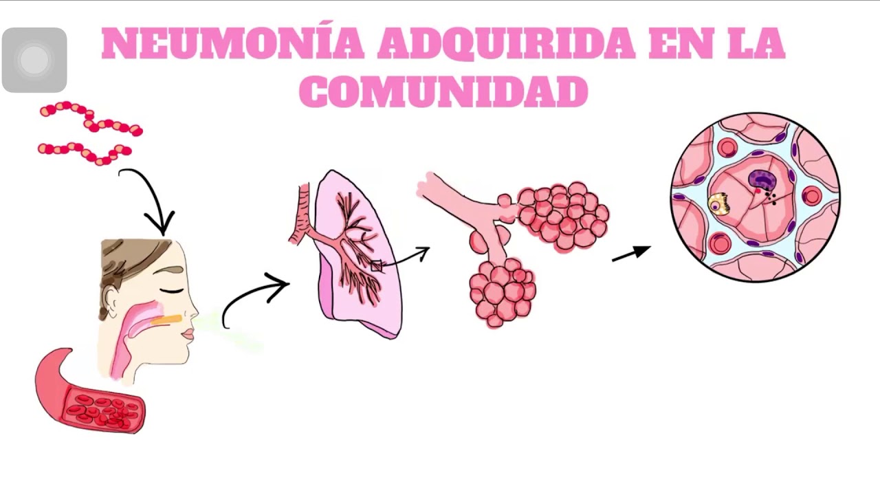 Fisiopatología de la Neumonía adquirida en la comunidad (en menos de 5 minutos)