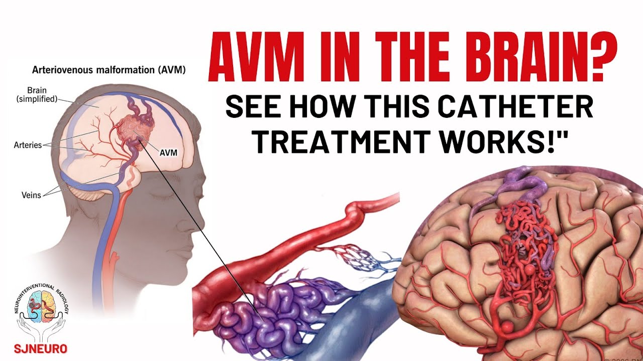 "Brain AVM Treatment Without Surgery | How Catheter Therapy Works!"