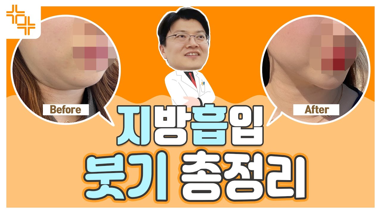 지방흡입 후 붓기 1일 차, 2일 차, 4일 차, 1주일 차, 2주 차 비교! 티티TV