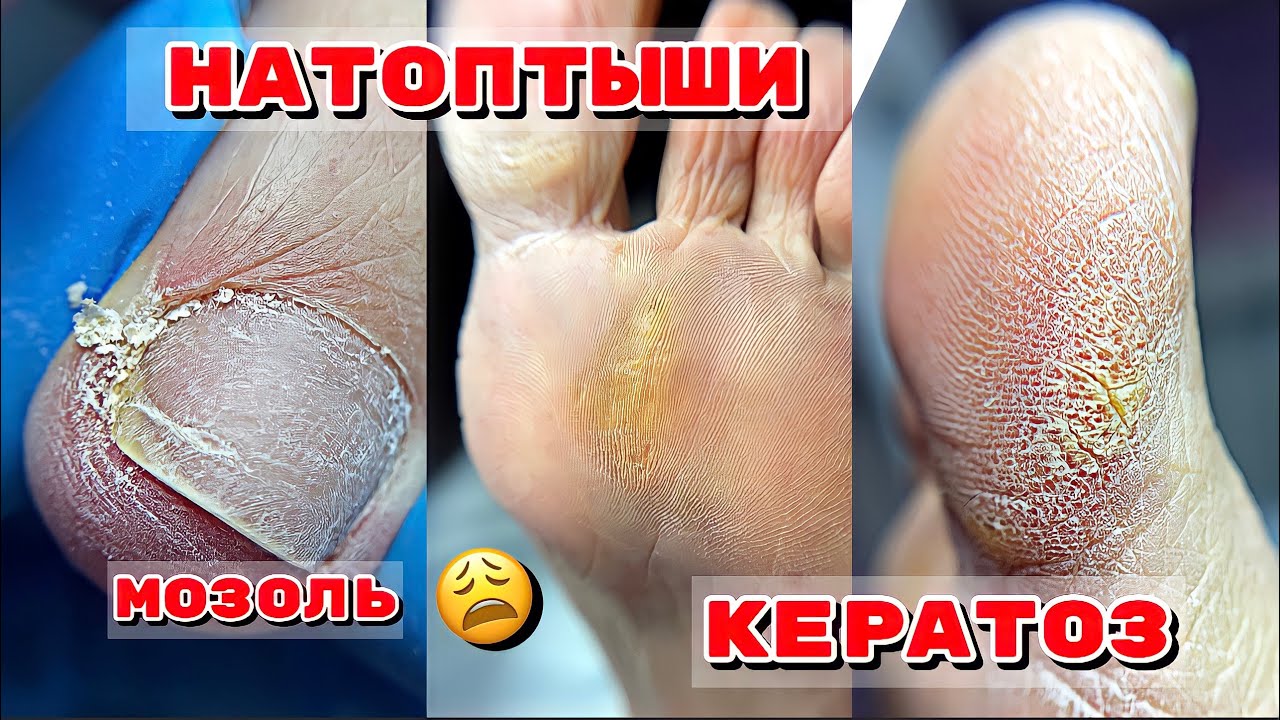 ОГРОМНЫЕ  НАТОПТЫШИ 😮 ПОДНОГТЕВАЯ МОЗОЛЬ 😮КЕРАТОЗ 💅 Педикюр на возрастных ногах