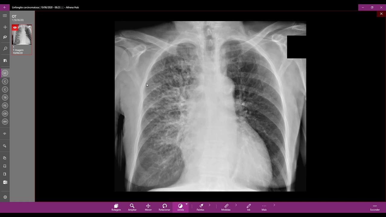 Linfangite carcinomatosa