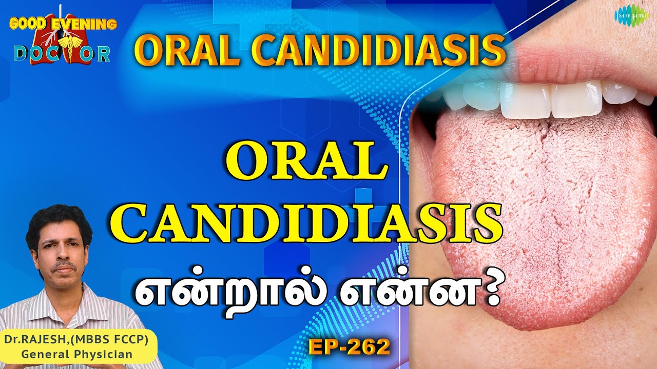 Oral Candidiasis என்றால் என்ன? | EP 262 | GOOD EVENING DOCTOR