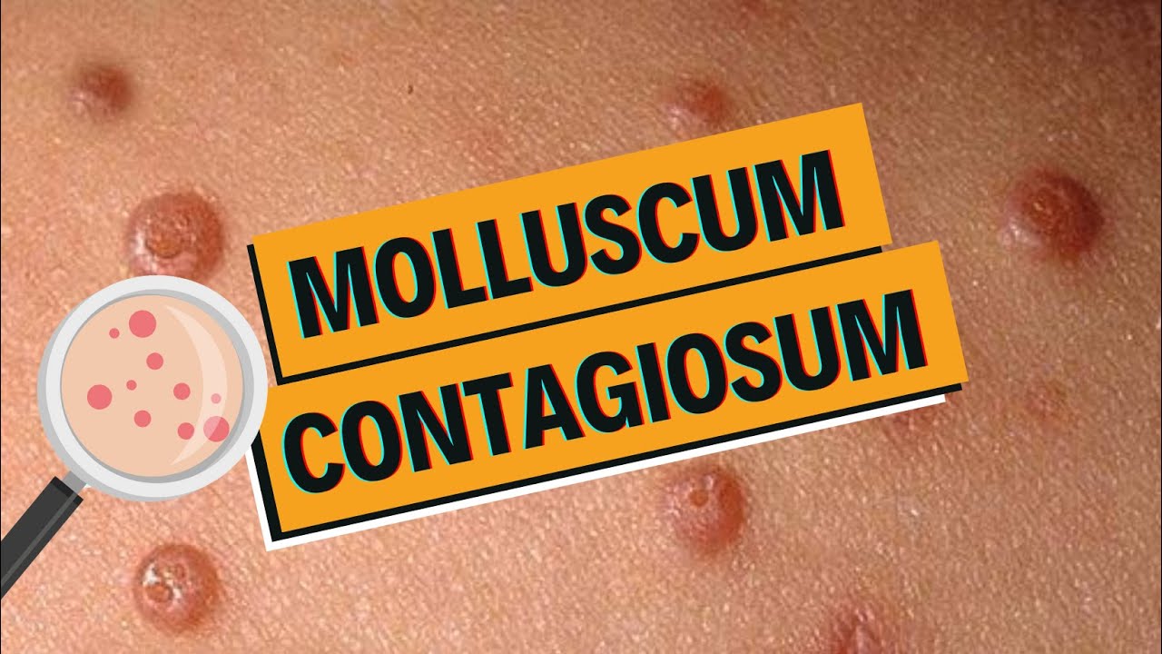 Molluscum contagiosum : comment les soigner ?