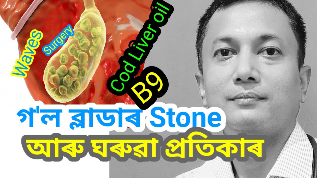Gallbladder Stone ৰ পৰা কেনেকৈ পৰিত্ৰাণ পাব পাৰি ? | Dr. Navajit Sahu