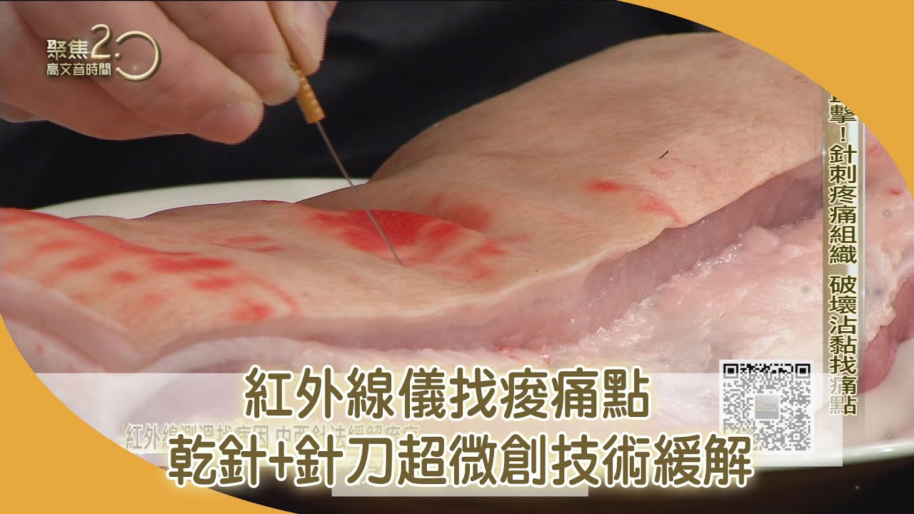 紅外線儀找痠痛點　乾針＋針刀超微創技術緩解【聚焦2.0】第435集