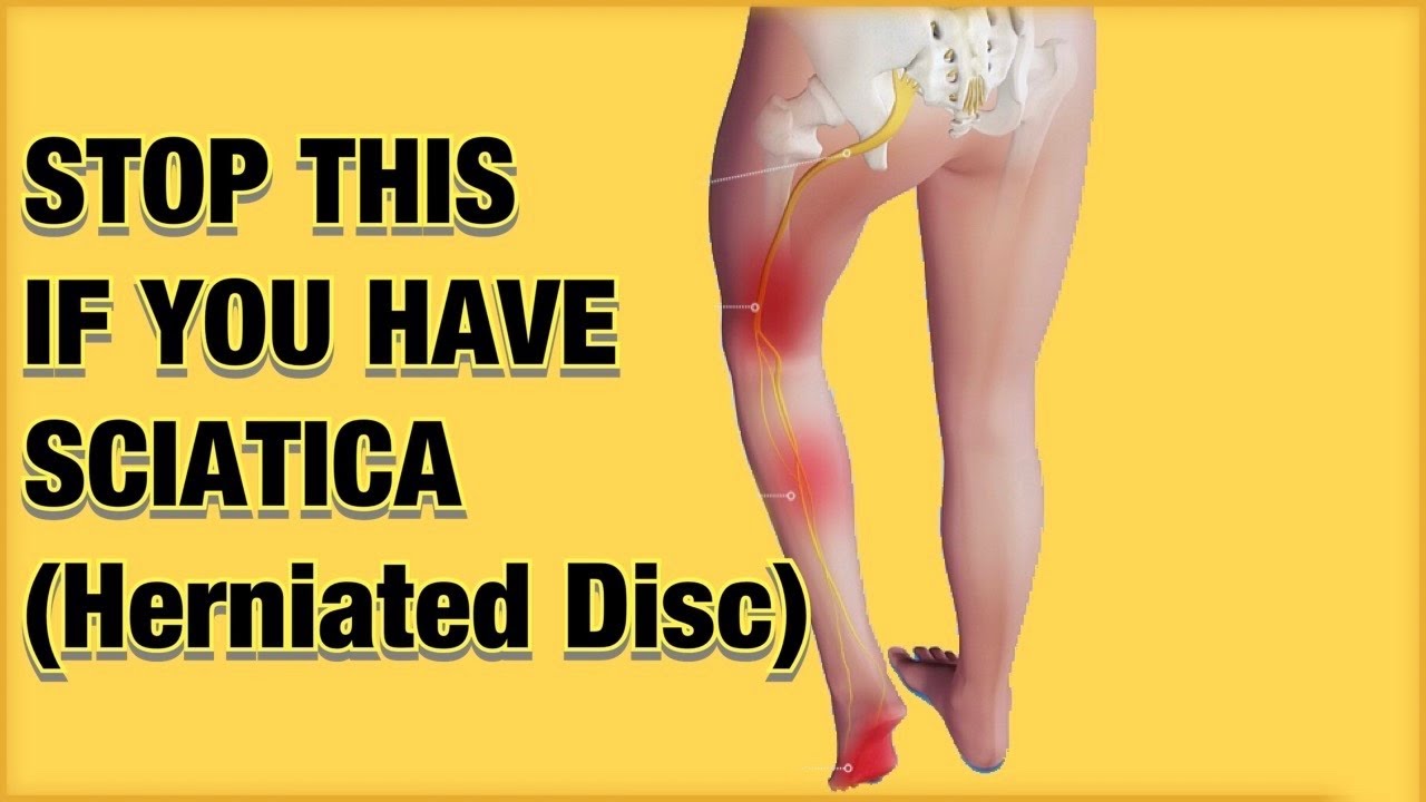 Sciatica Without Surgery , Ask A Physio (Herniated Disc)