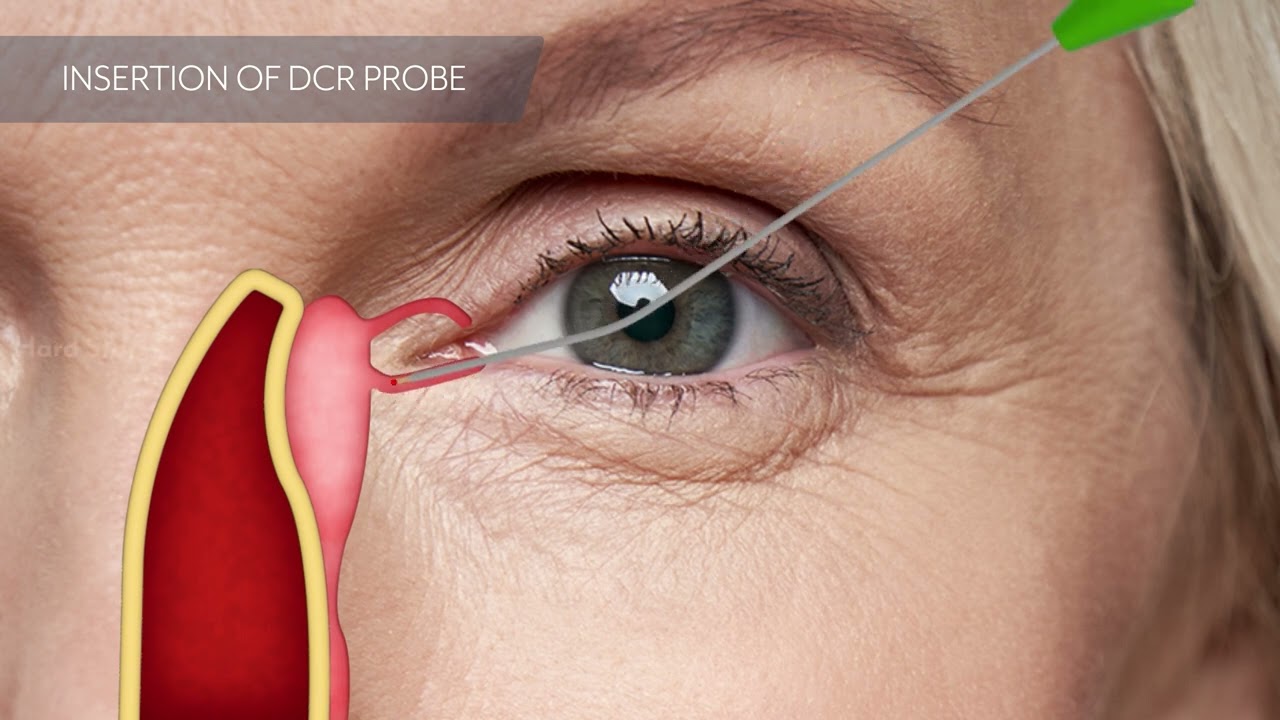 Animation: Transcanalicular laser-assisted dacryocystorhinostomy (TCL DCR) FOX Laser