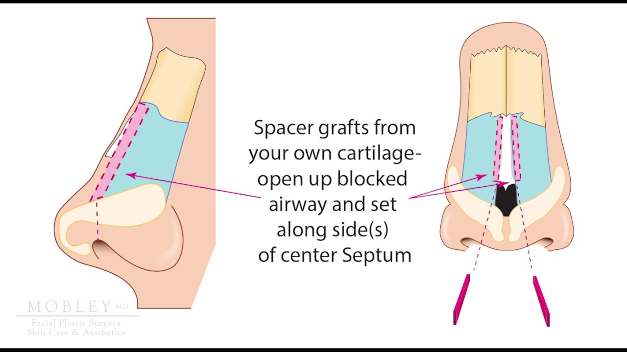 Understanding Nasal Valve Surgery