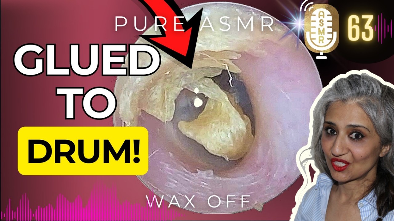 Wax Off ASMR Episode 63 | Rock-Hard Skin Glued To The Eardrum... Will It Come Out?