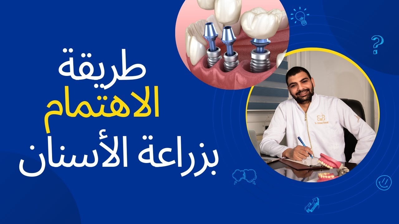 طريقة الاهتمام بزراعة الاسنان