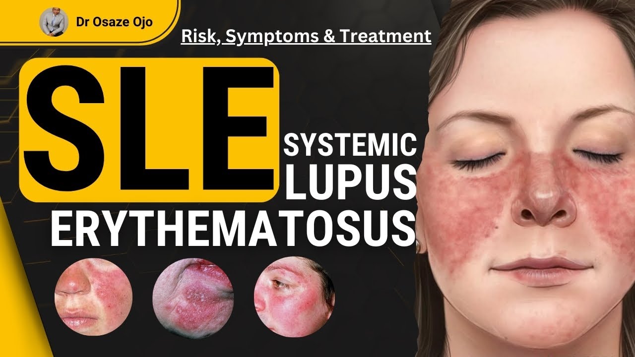 SLE systemic lupus erythematosus | Symptoms, Risks & What You Should Know
