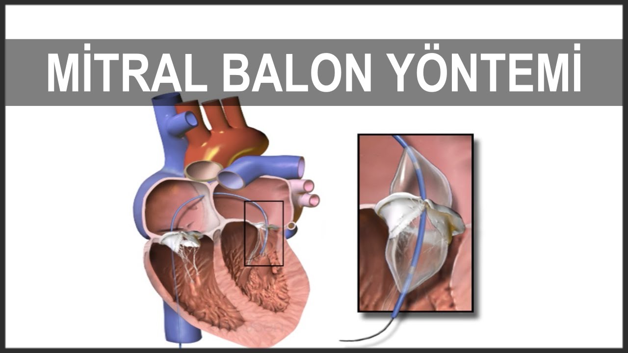 MİTRAL BALON YÖNTEMİ | Perkütan Balon Mitral Valvüloplasti (PBMV)