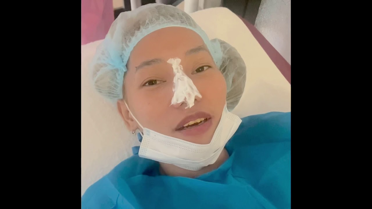 ONE YEAR FOLLOW UP OF HIKO THREADS NOSE LIFT WITH KOREAN FILLERS AT SKINOVATIVE CLINIC