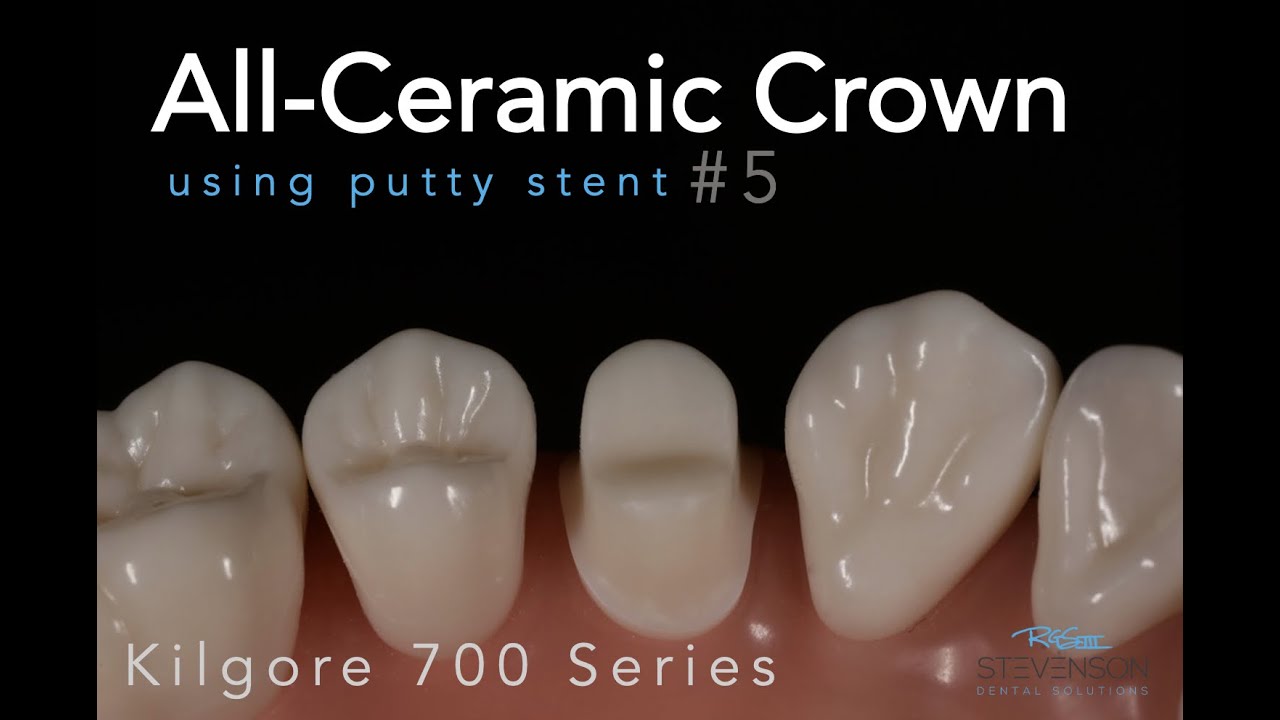 All Ceramic Prep #5 Kilgore 700 Series Typodont