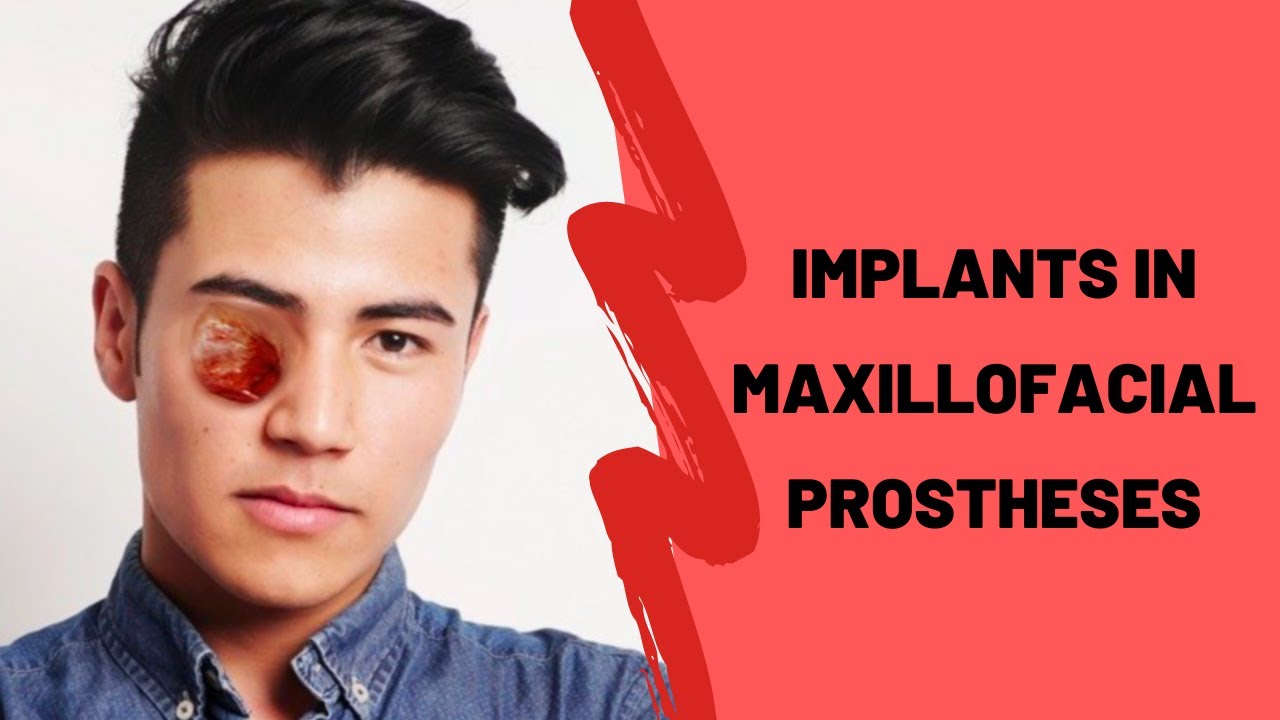 Implants in Maxillofacial Prostheses