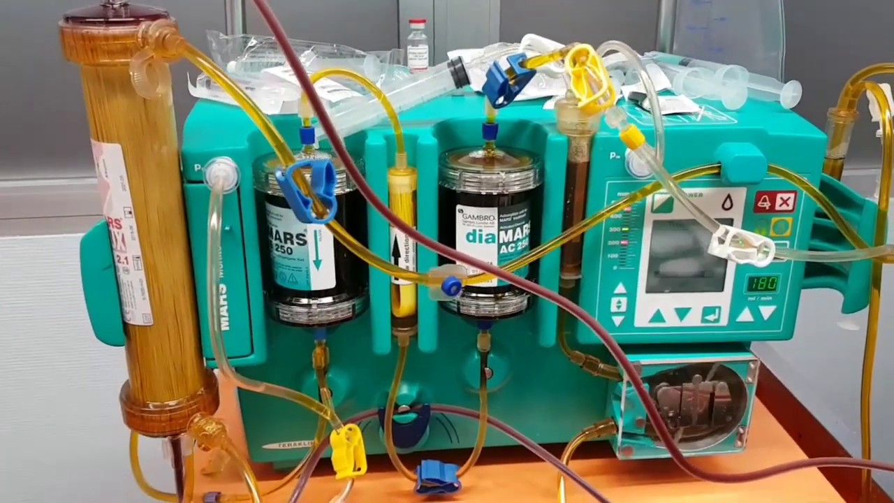 Hígado Artificial. Soporte Hepático Extracorpóreo, MARS - Molecular Adsorbent Recirculating System