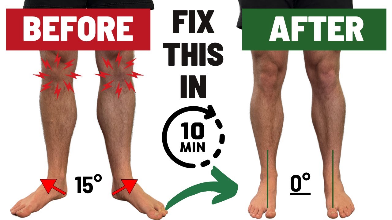 How To Fix Duck Feet FAST | Fixing Ankle Dorsiflexion, Tibial IR, & Hip IR