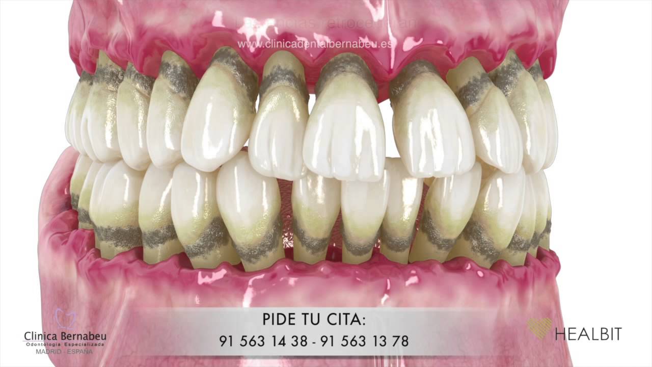 Periodoncia - gingivitis y periodontitis o 