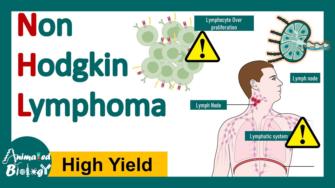 Неходжкинская лимфома | Патология и генетика неходжкинской лимфомы | Диагностика и лечение